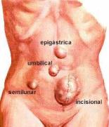 hernia